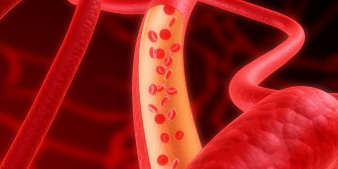 Атеросклероз сонной артерии лечение